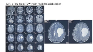 MRI of the brain T2WI with multiple axial section
 
