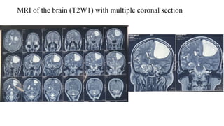 MRI of the brain (T2W1) with multiple coronal section
 