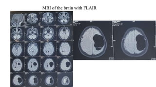 MRI of the brain with FLAIR
 