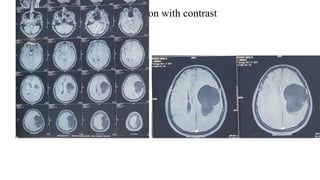 T1W1 multiple axial section with contrast
 