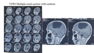 T2WI Multiple axial section with contrast
 