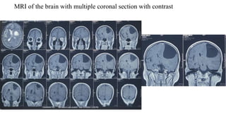 MRI of the brain with multiple coronal section with contrast
 