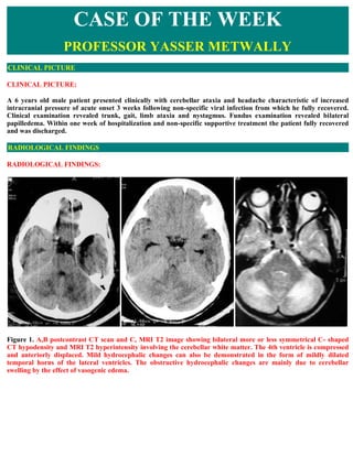 CASE OF THE WEEK
                  PROFESSOR YASSER METWALLY
CLINICAL PICTURE

CLINICAL PICTURE:

A 6 years old male patient presented clinically with cerebellar ataxia and headache characteristic of increased
intracranial pressure of acute onset 3 weeks following non-specific viral infection from which he fully recovered.
Clinical examination revealed trunk, gait, limb ataxia and nystagmus. Fundus examination revealed bilateral
papilledema. Within one week of hospitalization and non-specific supportive treatment the patient fully recovered
and was discharged.

RADIOLOGICAL FINDINGS

RADIOLOGICAL FINDINGS:




Figure 1. A,B postcontrast CT scan and C, MRI T2 image showing bilateral more or less symmetrical C- shaped
CT hypodensity and MRI T2 hyperintensity involving the cerebellar white matter. The 4th ventricle is compressed
and anteriorly displaced. Mild hydrocephalic changes can also be demonstrated in the form of mildly dilated
temporal horns of the lateral ventricles. The obstructive hydrocephalic changes are mainly due to cerebellar
swelling by the effect of vasogenic edema.
 