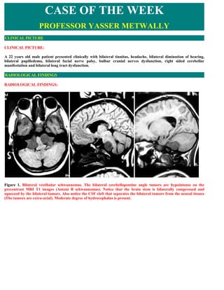 CASE OF THE WEEK
                    PROFESSOR YASSER METWALLY
CLINICAL PICTURE

CLINICAL PICTURE:

A 22 years old male patient presented clinically with bilateral tinnitus, headache, bilateral diminution of hearing,
bilateral papilledema, bilateral facial nerve palsy, bulbar cranial nerves dysfunction, right sided cerebellar
manifestation and bilateral long tract dysfunction.

RADIOLOGICAL FINDINGS

RADIOLOGICAL FINDINGS:




Figure 1. Bilateral vestibular schwannomas. The bilateral cerebellopontine angle tumors are hypointense on the
precontrast MRI T1 images (Antoni B schwannomas). Notice that the brain stem is bilaterally compressed and
squeezed by the bilateral tumors. Also notice the CSF cleft that separates the bilateral tumors from the neural tissues
(The tumors are extra-axial). Moderate degree of hydrocephalus is present.
 