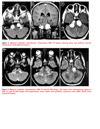 Figure 2. Bilateral vestibular schwannomas. Postcontrast MRI T1 images showing dense and uniform contrast
enhancement of t...