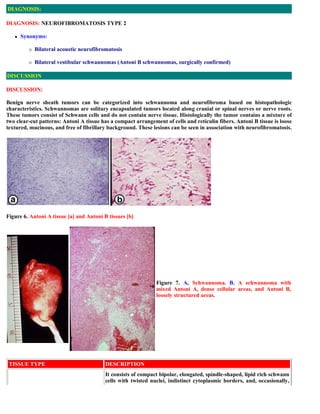 DIAGNOSIS:

DIAGNOSIS: NEUROFIBROMATOSIS TYPE 2

      Synonyms:

            Bilateral acoustic neurofibromatosis

    ...