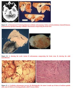 Figure 11. A, Postcontrast CT showing bilateral vestibular schwannomas. Notice central cavitations (Antoni B tissues),
B, ...