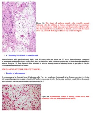 Figure 14. The sheets of uniform spindle cells resemble normal
                                             Schwann cells....
