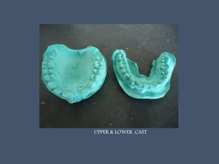 UPPER & LOWER CAST
 