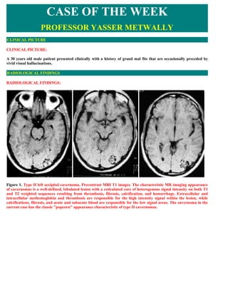 CASE OF THE WEEK
                   PROFESSOR YASSER METWALLY
CLINICAL PICTURE

CLINICAL PICTURE:

A 30 years old male patient presented clinically with a history of grand mal fits that are occasionally preceded by
vivid visual hallucinations.

RADIOLOGICAL FINDINGS

RADIOLOGICAL FINDINGS:




Figure 1. Type II left occipital cavernoma. Precontrast MRI T1 images. The characteristic MR imaging appearance
of cavernomas is a well-defined, lobulated lesion with a reticulated core of heterogenous signal intensity on both T1
and T2 weighted sequences resulting from thrombosis, fibrosis, calcification, and hemorrhage. Extracellular and
intracellular methemoglobin and thrombosis are responsible for the high intensity signal within the lesion, while
calcifications, fibrosis, and acute and subacute blood are responsible for the low signal areas. The cavernoma in the
current case has the classic quot;popcornquot; appearance characteristic of type II cavernomas.
 
