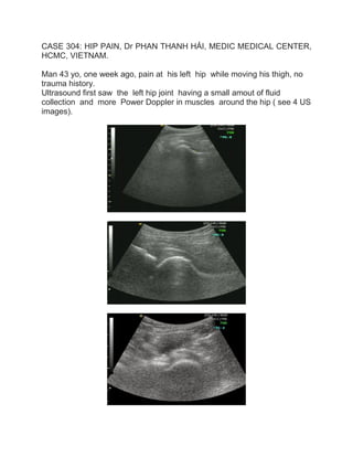 CASE 304: HIP PAIN, Dr PHAN THANH HẢI, MEDIC MEDICAL CENTER,
HCMC, VIETNAM.
Man 43 yo, one week ago, pain at his left hip while moving his thigh, no
trauma history.
Ultrasound first saw the left hip joint having a small amout of fluid
collection and more Power Doppler in muscles around the hip ( see 4 US
images).
 