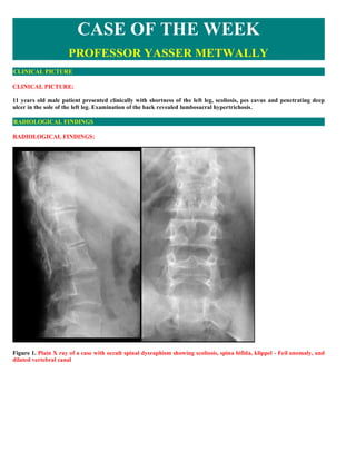 CASE OF THE WEEK
                     PROFESSOR YASSER METWALLY
CLINICAL PICTURE

CLINICAL PICTURE:

11 years old male patient presented clinically with shortness of the left leg, scoliosis, pes cavus and penetrating deep
ulcer in the sole of the left leg. Examination of the back revealed lumbosacral hypertrichosis.

RADIOLOGICAL FINDINGS

RADIOLOGICAL FINDINGS:




Figure 1. Plain X ray of a case with occult spinal dysraphism showing scoliosis, spina bifida, klippel - Feil anomaly, and
dilated vertebral canal
 