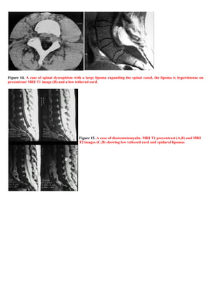 Case record... Spinal dysraphism