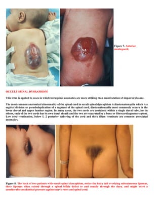 Case record... Spinal dysraphism