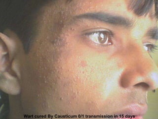 Wart cured By Causticum 0/1 transmission in 15 days
 