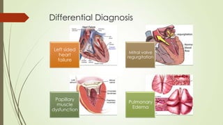 Papillary Dysfunction Papillary rupture | PPTX
