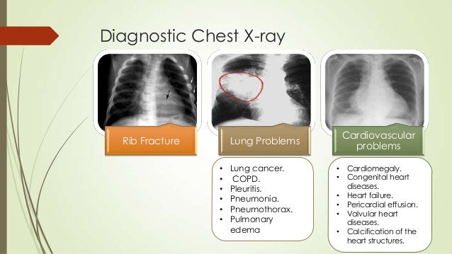 Papillary rupture Papillary rupture