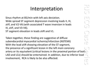 RJS ECG Case Series
                      Interpretation
Sinus rhythm at 85/min with left axis deviation.
Wide spread ST segment depression involving leads II, III,
aVF, and V2-V6 (with associated T wave inversion in leads
III, aVF, and V3-V6).
ST segment elevation in leads aVR and V1.

Taken together, these finding are suggestive of diffuse
subendocardial myocardial ischemia/infarction (NSTEMI)
With the lead aVR showing elevation of the ST segment,
the presence of a significant lesion in the left main coronary
artery or its equivalent (critical lesions in the proximal portion of both
LAD and LCx) should be entertained. In addition, due to inferior lead
involvement, RCA is likely to be also affected.
 