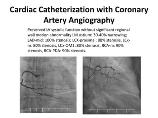 Cardiac Catheterization with Coronary
         Artery Angiography
    Preserved LV systolic function without significant regional
    wall motion abnormality LM ostium: 30-40% narrowing;
    LAD-mid: 100% stenosis; LCX-proximal: 80% stenosis, LCx-
    m: 80% stenosis, LCx-OM1: 80% stenosis; RCA-m: 90%
    stenosis, RCA-PDA: 90% stenosis.
 