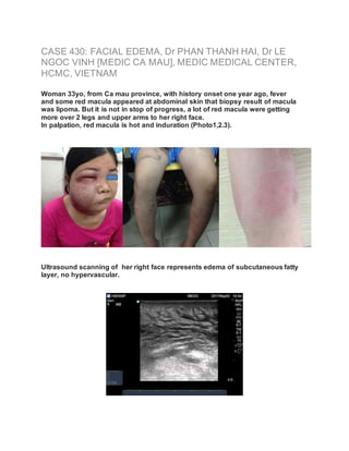 CASE 430: FACIAL EDEMA, Dr PHAN THANH HAI, Dr LE
NGOC VINH [MEDIC CA MAU], MEDIC MEDICAL CENTER,
HCMC, VIETNAM
Woman 33yo, from Ca mau province, with history onset one year ago, fever
and some red macula appeared at abdominal skin that biopsy result of macula
was lipoma. But it is not in stop of progress, a lot of red macula were getting
more over 2 legs and upper arms to her right face.
In palpation, red macula is hot and induration (Photo1,2.3).
Ultrasound scanning of her right face represents edema of subcutaneous fatty
layer, no hypervascular.
 
