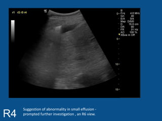 R4 Suggestion of abnormality in small effusion - 
prompted further investigation , an R6 view. 
 