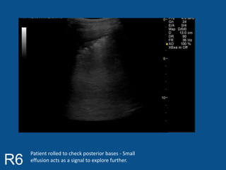R6 Patient rolled to check posterior bases - Small 
effusion acts as a signal to explore further. 
 