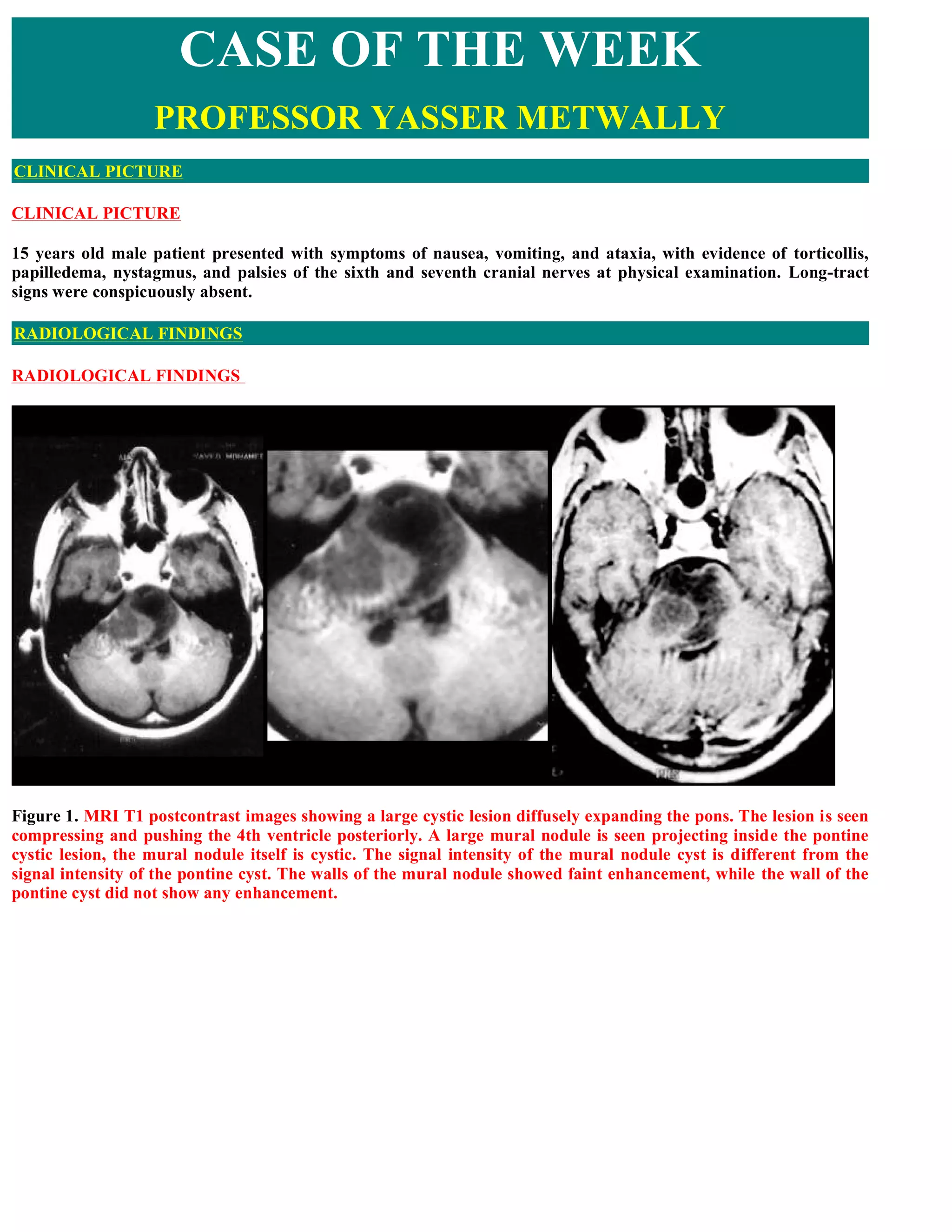 Case record...Brain stem pilocytic astrocytoma | PDF