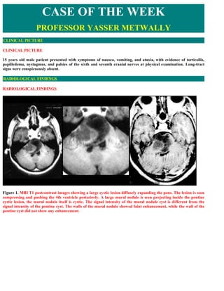 CASE OF THE WEEK
                   PROFESSOR YASSER METWALLY
CLINICAL PICTURE

CLINICAL PICTURE

15 years old male patient presented with symptoms of nausea, vomiting, and ataxia, with evidence of torticollis,
papilledema, nystagmus, and palsies of the sixth and seventh cranial nerves at physical examination. Long-tract
signs were conspicuously absent.

RADIOLOGICAL FINDINGS

RADIOLOGICAL FINDINGS  




Figure 1. MRI T1 postcontrast images showing a large cystic lesion diffusely expanding the pons. The lesion is seen
compressing and pushing the 4th ventricle posteriorly. A large mural nodule is seen projecting inside the pontine
cystic lesion, the mural nodule itself is cystic. The signal intensity of the mural nodule cyst is different from the
signal intensity of the pontine cyst. The walls of the mural nodule showed faint enhancement, while the wall of the
pontine cyst did not show any enhancement.
 