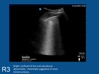 R3 
Bright, confluent B line and sub-pleural 
abnormality - Potentially suggestive of more 
chronic process. 
 