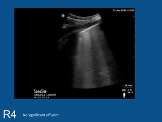 R4 No significant effusion 
 