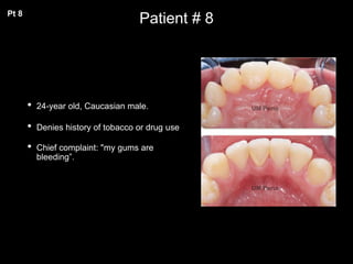 Patient # 8
• 24-year old, Caucasian male.
• Denies history of tobacco or drug use
• Chief complaint: "my gums are
bleeding”.
Pt 8
 