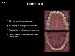 Patient # 9
• 27-year old, Caucasian male.
• No history of any systemic disease.
• Denies history of tobacco or drug use
• Chief complaint: "I might have some
mobile teeth"
Pt 9
 