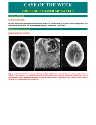 CASE OF THE WEEK
                   PROFESSOR YASSER METWALLY
CLINICAL PICTURE

CLINICAL PICTURE:

60 years male diabetic patient presented clinically with fever, manifestations of increased intracranial pressure, and
meningeal irritation signs. The patient was also suffering from chronic renal failure.

RADIOLOGICAL FINDINGS

RADIOLOGICAL FINDINGS:




Figure 1. Postcontrast CT scan images showing multiple multilocular cerebral abscesses, with densely enhanced
capsules. The abscesses are mainly situated at the gray/white matter junction and most probably they are of
hematogenous origin. Also noted non-cystic hypodense areas, probably representing early cerebritis stage. Most of
the abscesses are situated in the frontal lobe.
 