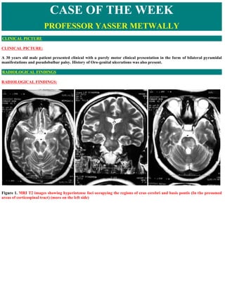 CLINICAL PICTURE:
A 30 years old male patient presented clinical with a purely motor clinical presentation in the form of bilateral pyramidal
manifestations and pseudobulbar palsy. History of Oro-genital ulcerations was also present.
RADIOLOGICAL FINDINGS:
Figure 1. MRI T2 images showing hyperintense foci occupying the regions of crus cerebri and basis pontis (In the presumed
areas of corticospinal tract) (more on the left side)
CASE OF THE WEEK
PROFESSOR YASSER METWALLY
CLINICAL PICTURE
RADIOLOGICAL FINDINGS
 