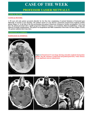 CASE OF THE WEEK
                        PROFESSOR YASSER METWALLY
CLINICAL PICTURE

CLINICAL PICTURE:

A 50 years old male patient presented clinically for the first time complaining of marked limitation of horizontal gaze
bilaterally of around 4 years duration. The patient's brain CT scan showed a posteriorly located focal exophytic pontine
glioma (Figure 1). At the time of the first presentation the patient refused any treatment or further investigation. Two years
later the patient presented with a rapidly progressive bilateral weakness, sever headache, bilateral papilledema, vertigo and
bilateral cerebellar manifestations. The patient was hospitalized and MRI examination of the brain was done (Figure 2,3,4,5).
The patient suddenly died 2 days later.

RADIOLOGICAL FINDINGS

RADIOLOGICAL FINDINGS:




                                             Figure 1. Postcontrast CT scan image showing a dorsally exophytic focal pontine
                                             glioma. The 4th ventricle is compressed and pushed posteriorly. Notice absence
                                             of any significant contrast enhancement.
 