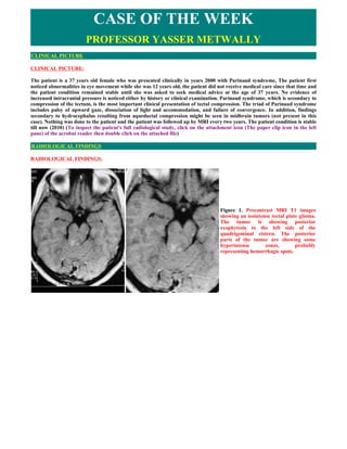 CASE OF THE WEEK
                        PROFESSOR YASSER METWALLY
CLINICAL PICTURE

CLINICAL PICTURE:

The patient is a 37 years old female who was presented clinically in years 2000 with Parinaud syndrome, The patient first
noticed abnormalities in eye movement while she was 12 years old, the patient did not receive medical care since that time and
the patient condition remained stable until she was asked to seek medical advice at the age of 37 years. No evidence of
increased intracranial pressure is noticed either by history or clinical examination. Parinaud syndrome, which is secondary to
compression of the tectum, is the most important clinical presentation of tectal compression. The triad of Parinaud syndrome
includes palsy of upward gaze, dissociation of light and accommodation, and failure of convergence. In addition, findings
secondary to hydrocephalus resulting from aqueductal compression might be seen in midbrain tumors (not present in this
case). Nothing was done to the patient and the patient was followed up by MRI every two years. The patient condition is stable
till now (2010) (To inspect the patient's full radiological study, click on the attachment icon (The paper clip icon in the left
pane) of the acrobat reader then double click on the attached file)

RADIOLOGICAL FINDINGS

RADIOLOGICAL FINDINGS:




                                                                                    Figure 1. Precontrast MRI T1 images
                                                                                    showing an isointense tectal plate glioma.
                                                                                    The tumor is showing posterior
                                                                                    exophytosis to the left side of the
                                                                                    quadrigeminal cistern. The posterior
                                                                                    parts of the tumor are showing some
                                                                                    hyperintense       zones,        probably
                                                                                    representing hemorrhagic spots.
 