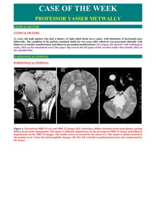 CASE OF THE WEEK
                   PROFESSOR YASSER METWALLY
CLINICAL PICTURE

CLINICAL PICTURE:

11 years old male patient who had a history of right sided facial nerve palsy, with limitation of horizontal gaze
bilaterally. The condition of the patient remained stable for two years after which he was presented clinically with
bilateral cerebellar manifestation and bilateral pyramidal manifestations. (To inspect the patient's full radiological
study, click on the attachment icon (The paper clip icon in the left pane) of the acrobat reader then double click on
the attached file)

RADIOLOGICAL FINDINGS

RADIOLOGICAL FINDINGS:




Figure 1. Precontrast MRI T1 (A) and MRI T2 images (B,C) showing a diffuse intrinsic brain stem glioma causing
diffuse brain stem enlargement. The tumor is diffusely hypointense on the precontrast MRI T1 image and diffusely
hyperintense on the MRI T2 images. The basilar artery is encased by the tumor (C). The tumor is mainly located at
the pontine level. Notice the hydrocephalic changes. (B) The 4th ventricle is pushed posteriorly and compressed by
the tumor.
 