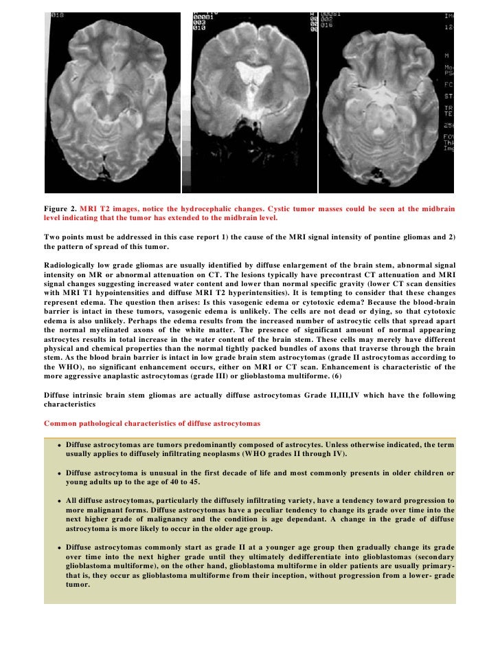 Adult brain stem glioma, nude men in jeans