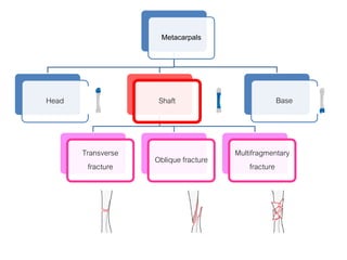 Metacarpals
Head Shaft
Transverse
fracture
Oblique fracture
Multifragmentary
fracture
Base
 