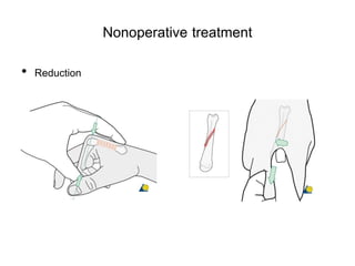 Nonoperative treatment
• Reduction
 