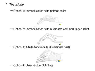 • Technique
–Option 1: Immobilization with palmar splint
–Option 2: Immobilization with a forearm cast and finger splint
–Option 3: Attelle fonctionelle (Functional cast)
–Option 4: Ulnar Gutter Splinting
 