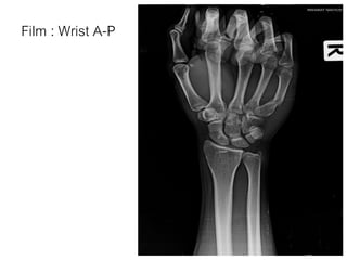 Film : Wrist A-P
 