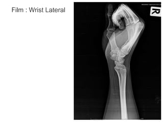 Film : Wrist Lateral
 