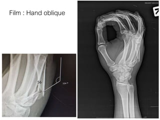 Film : Hand oblique
56
 