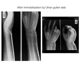 After Immobilization by Ulnar gutter slab
 