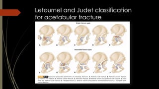 Judet Letournel Classification Hip dislocation | PDF