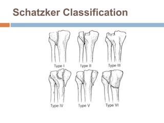 Scthker Classification Tibial plateau fracture | PPTX
