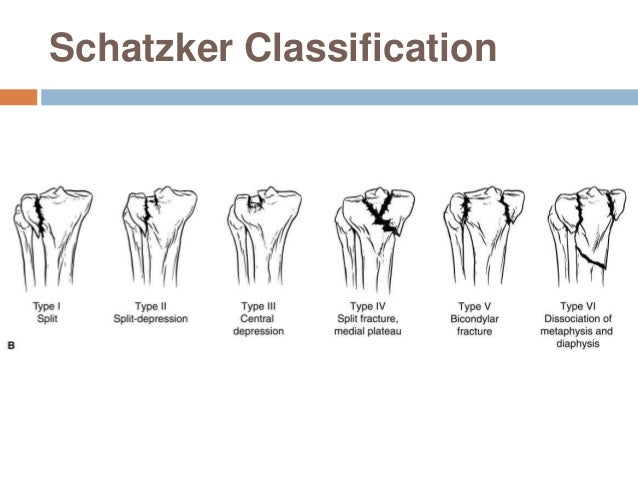 tibial-plateau-fracture-21-638.jpg