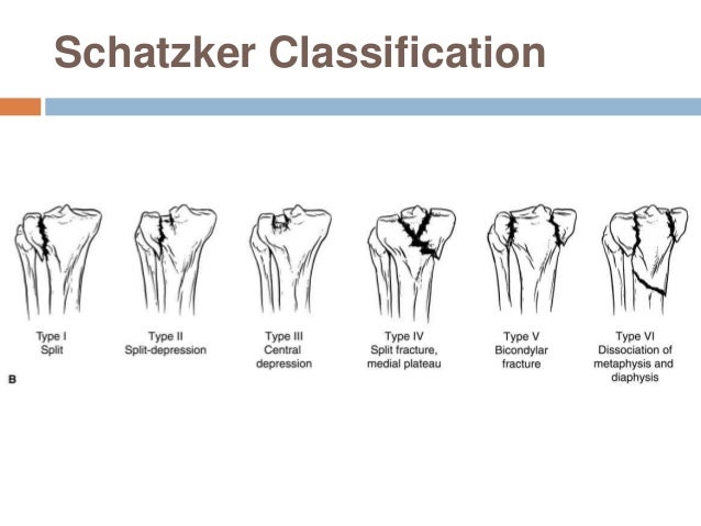 Tibial Plateau Fracture