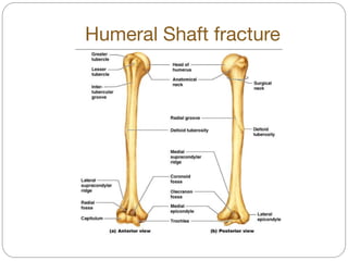 Humeral Shaft fracture
 